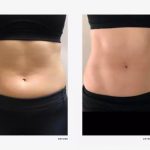 Body Sculpting in Jericho NY