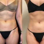 Enhanced Emsculpt in Jericho NY