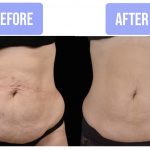 Skin Tightening in Jericho NY
